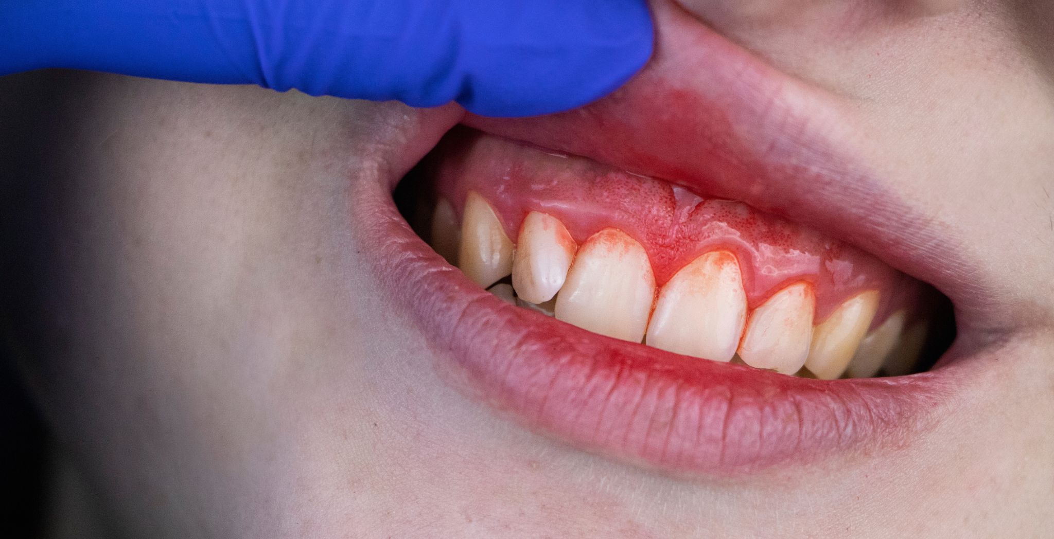 Gingivitis vs Periodontitis