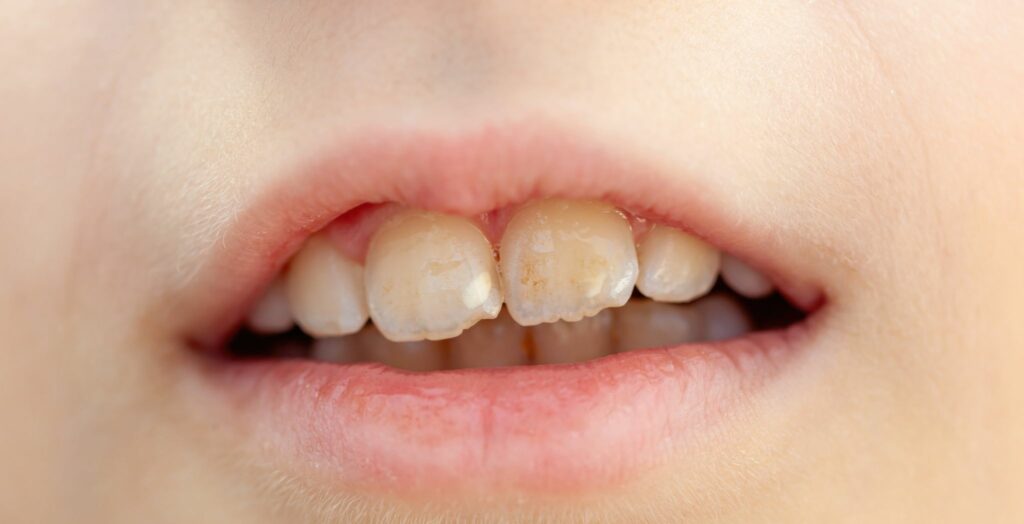 Dental erosion causes, Tooth enamel erosion, Acid erosion of teeth, Signs of dental erosion, Preventing dental erosion, Enamel loss in teeth, Effects of acidic foods on teeth, Dental erosion treatment