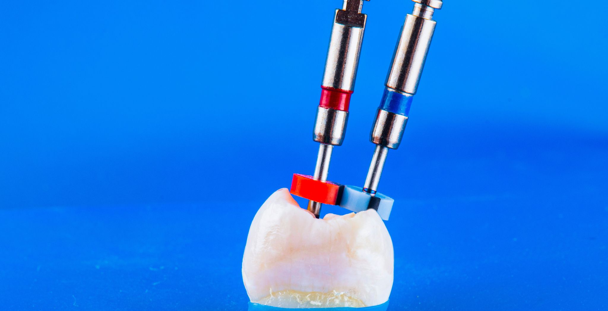 How Long Does a Root Canal Take, Root canal procedure time, Duration of a root canal, Time needed for root canal treatment, Root canal dental procedure length, Average root canal time, Steps in a root canal procedure,Which stage of root canal is most painful, How long does it take to recover from a root canal, Root canal stage 2 pain, Third sitting of root canal is painful, Root canal stage 1 pain, How long between root canal appointments, Stages of root canal,