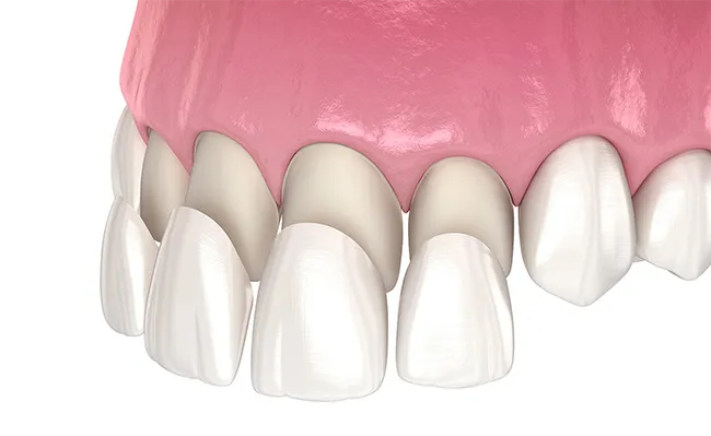 Do Dental Veneers Damage Teeth