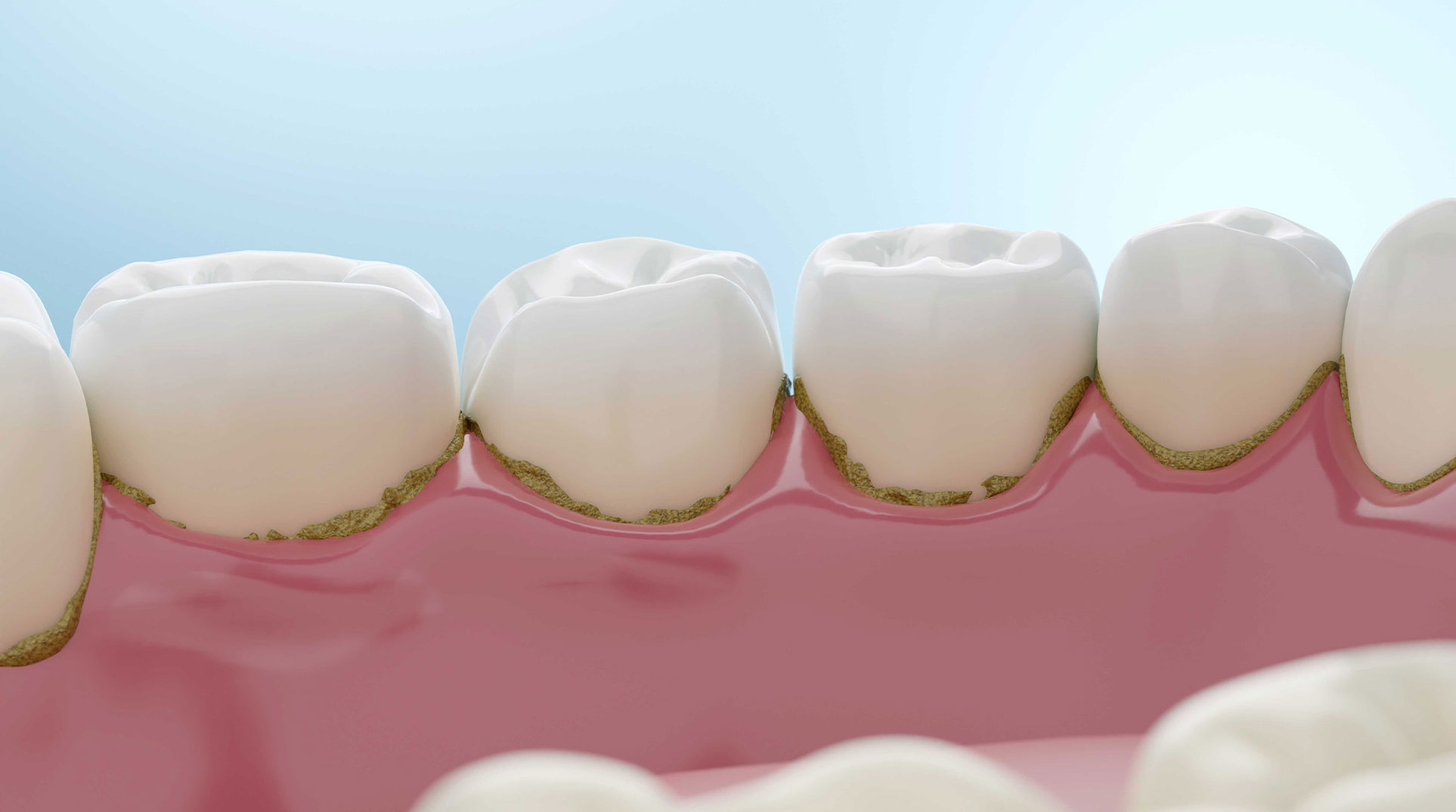 What Is Plaque on Teeth and How to Remove It