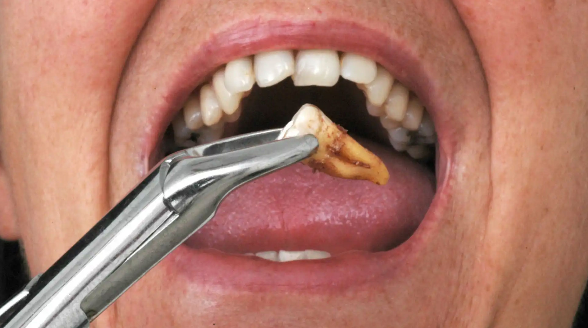Avoiding Dry Socket After Wisdom Teeth Removal